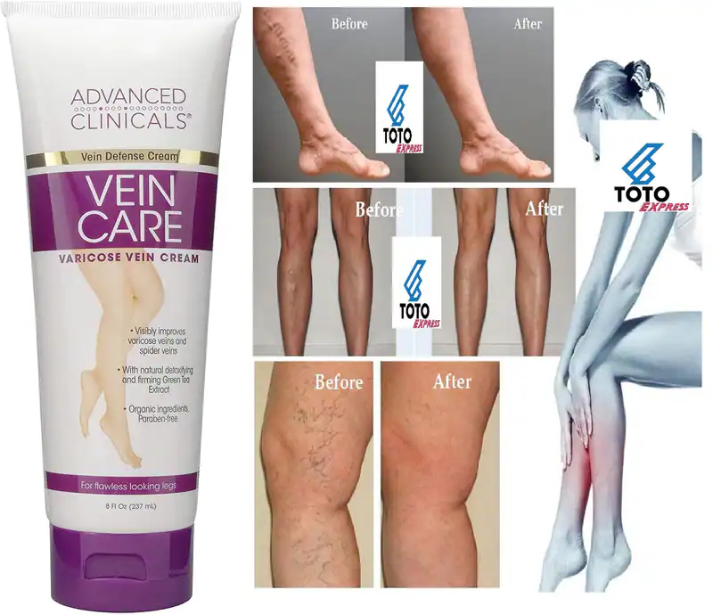#1 Crema Para Las Varices Borra Las Venas Varicosas Elimina Verrugas y Arañitas